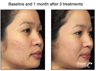 Fraxel for facial acne photo