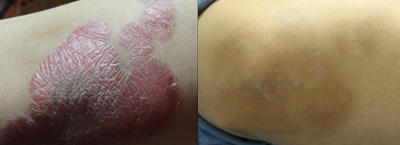 psoriasis before-after