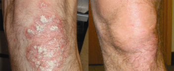 psoriasis before-after