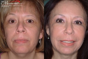 Fillers before & after