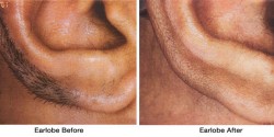 Earlobe_Before-after