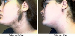 face-sideburn-before-after