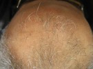 hair-transplant1-before