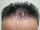 hair-transplant2-after
