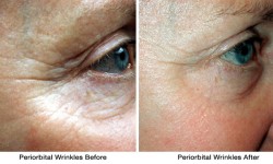 periorbital-wrinkles-before_after