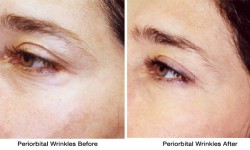 periorbital-wrinkles2-before_after
