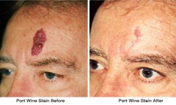 Port_Wine_Stain-before_after