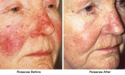 Rosacea1-before_after