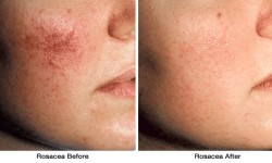 Rosacea2-before_after