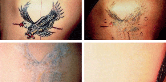 532 nm - Targeting Red Ink - Picosure Laser Tattoo Removal in Bristol