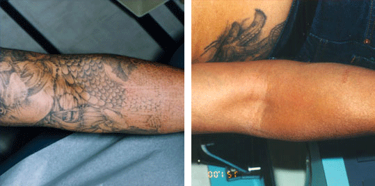 The Best Laser Tattoo Removal Available Now  NAAMA Studios