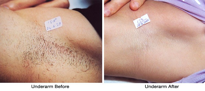 underarm waxing before and after