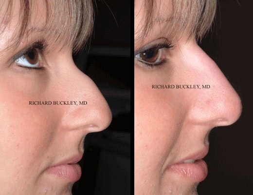 Non-surgical Rhinoplasty Before and After - Milford MD, Milford, PA